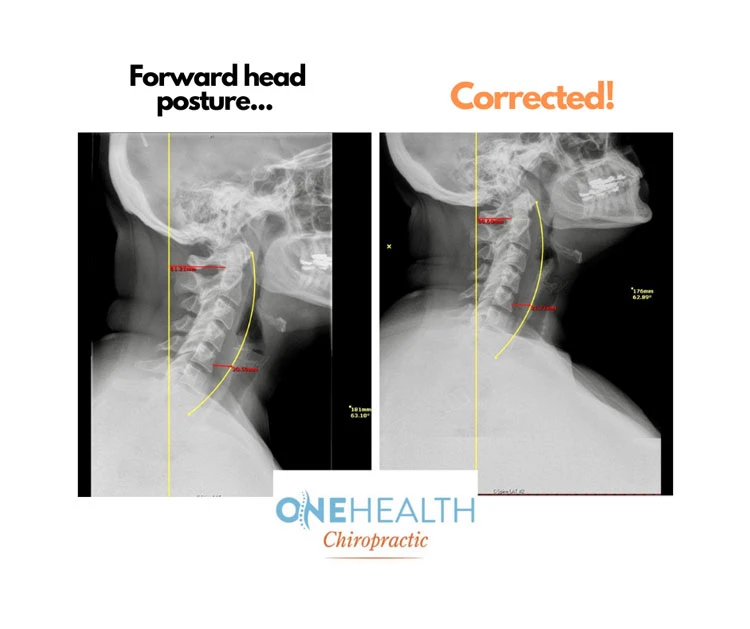 Before and after x-rays of a patient's neck, before and after adjustment